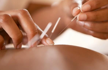 Two hands applying acupuncture